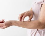 L'eczéma au quotidien